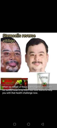 Vitiligo kit Remedy
